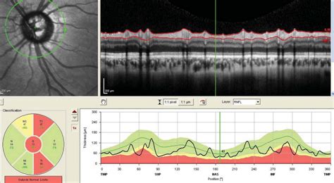 my oct test for thickness was 0.78|how to read octs in eye.